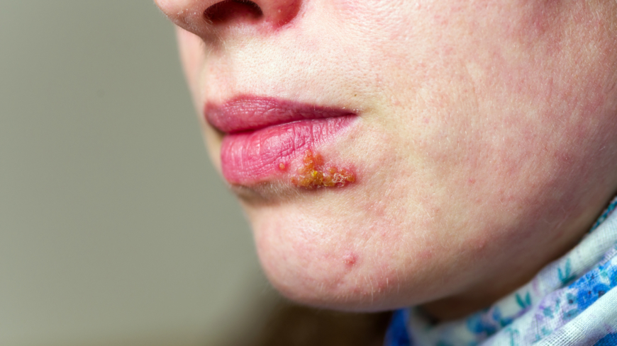 Kaikki suun herpeksestä (Herpes simplex) – oireet, syy ja hoito